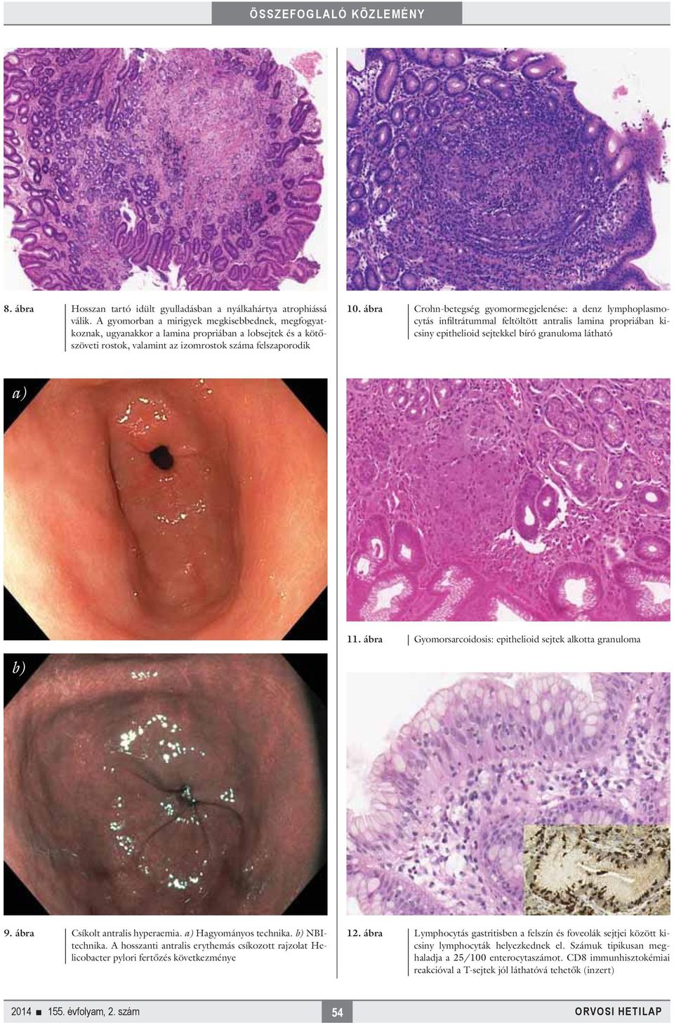 ábra Crohn-betegség gyomormegjelenése: a denz lymphoplasmocytás infiltrátummal feltöltött antralis lamina propriában kicsiny epithelioid sejtekkel bíró granuloma látható a) 11.