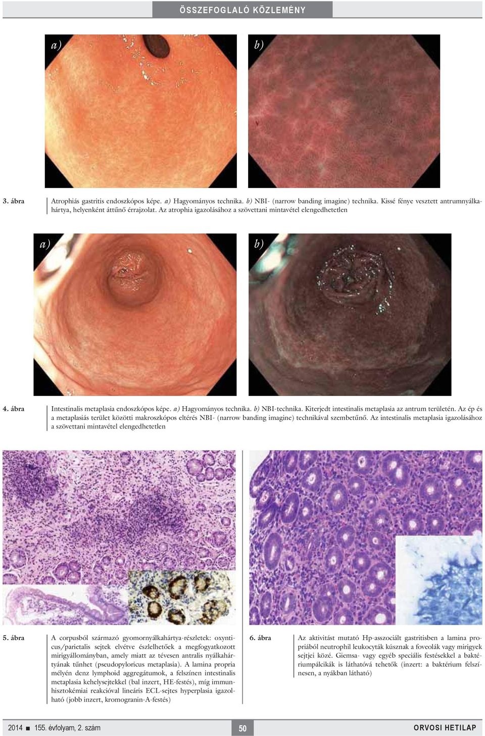 Kiterjedt intestinalis metaplasia az antrum területén. Az ép és a metaplasiás terület közötti makroszkópos eltérés NBI- (narrow banding imagine) technikával szembetűnő.