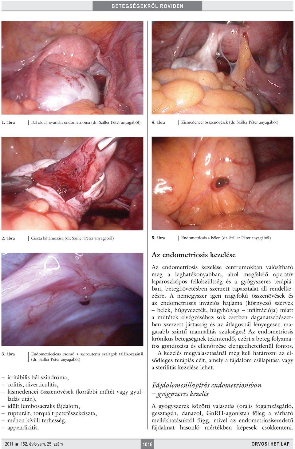 Sziller Péter anyagából) irritábilis bél szindróma, colitis, diverticulitis, kismedencei összenövések (korábbi műtét vagy gyulladás után), idült lumbosacralis fájdalom, rupturált, torquált