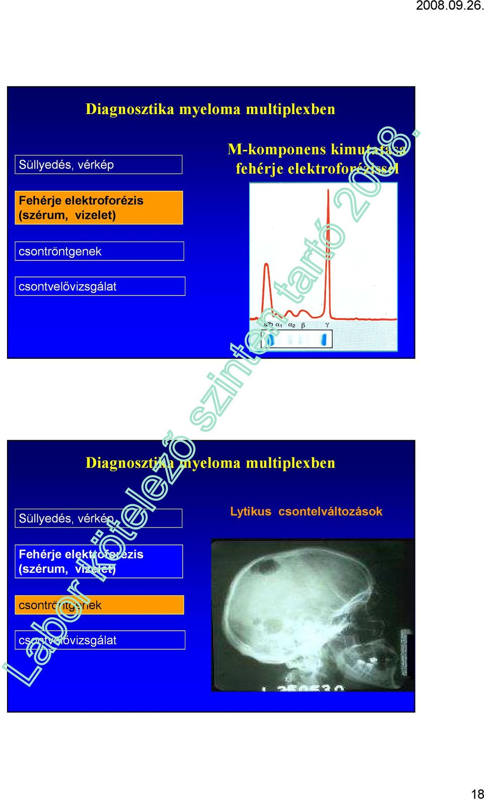 csontvelővizsgálat Diagnosztika myeloma multiplexben Süllyedés, vérkép Lytikus