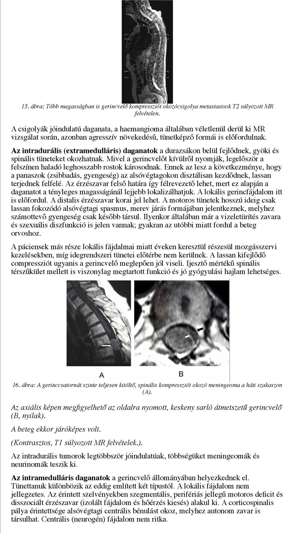 Az intradurális (extramedulláris) daganatok a durazsákon belül fejlődnek, gyöki és spinális tüneteket okozhatnak.