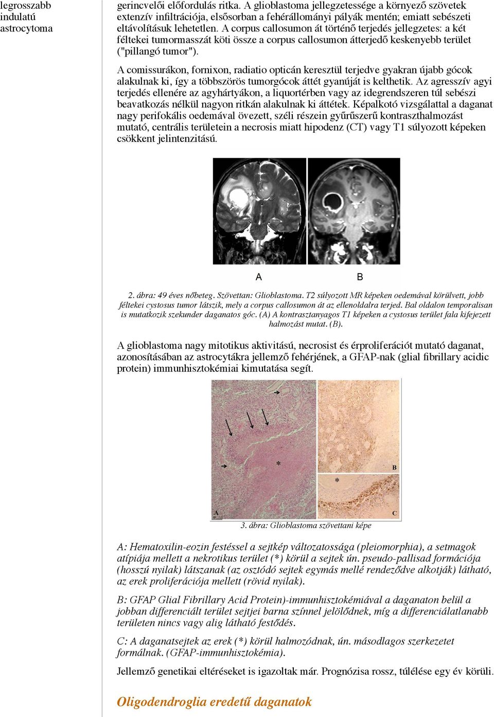 A corpus callosumon át történő terjedés jellegzetes: a két féltekei tumormasszát köti össze a corpus callosumon átterjedő keskenyebb terület ("pillangó tumor").