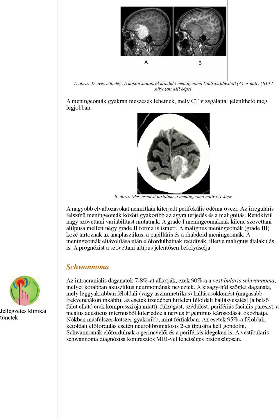 ábra: Meszesedést tartalmazó meningeoma natív CT képe A nagyobb elváltozásokat nemritkán kiterjedt perifokális ödéma övezi.