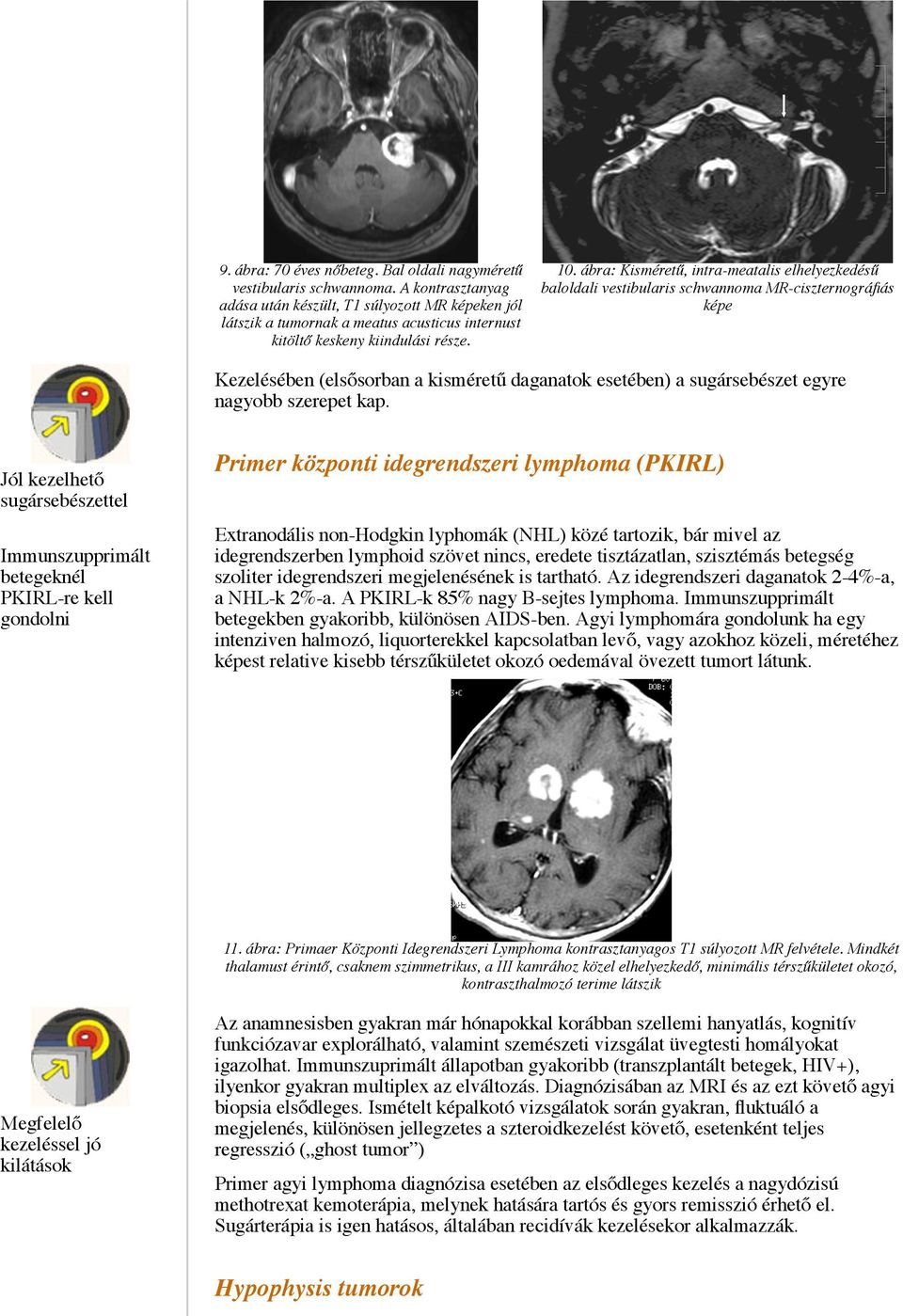 ábra: Kisméretű, intra-meatalis elhelyezkedésű baloldali vestibularis schwannoma MR-ciszternográfiás képe Kezelésében (elsősorban a kisméretű daganatok esetében) a sugársebészet egyre nagyobb