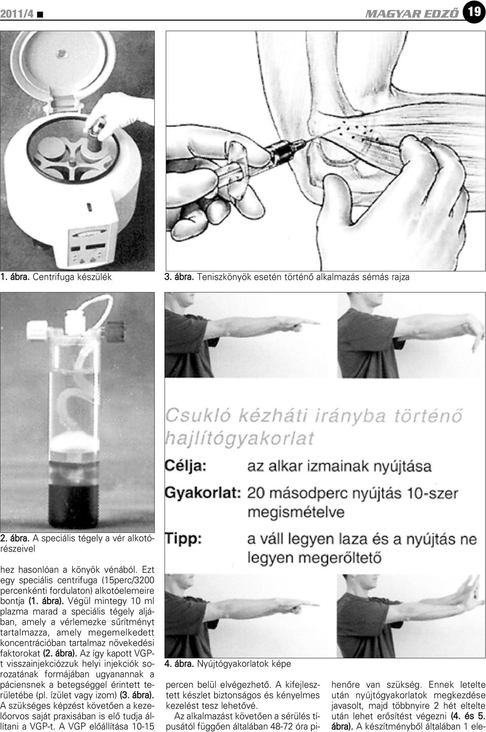 Végül mintegy 10 ml plazma marad a speciális tégely aljában, amely a vérlemezke sûrítményt tartalmazza, amely megemelkedett koncentrációban tartalmaz növekedési faktorokat (2. ábra).