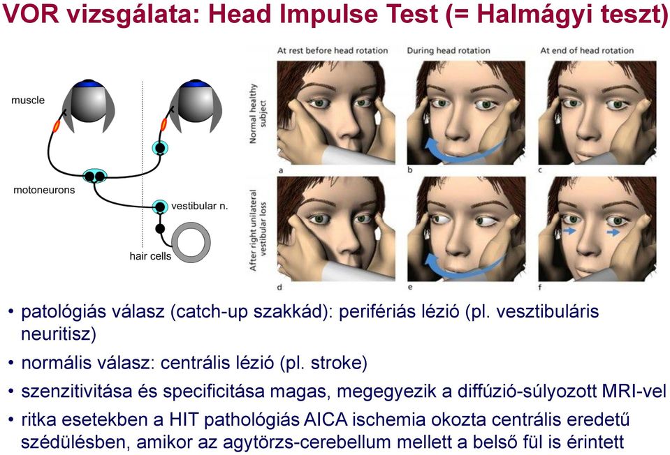 stroke) szenzitivitása és specificitása magas, megegyezik a diffúzió-súlyozott MRI-vel ritka esetekben