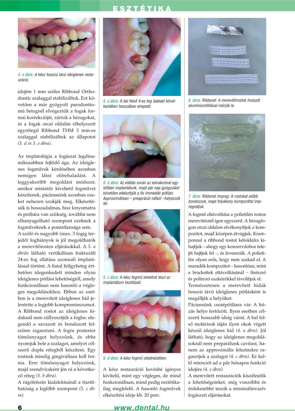stabilizáltuk az állapotot (3. d és 3. e ábra). 5. a ábra: A bal felsô 4-es fog baleset következtében hosszában elrepedt. 6. ábra: Ribbond: A merevítôrostok hosszát alumíniumfóliával mérjük le.