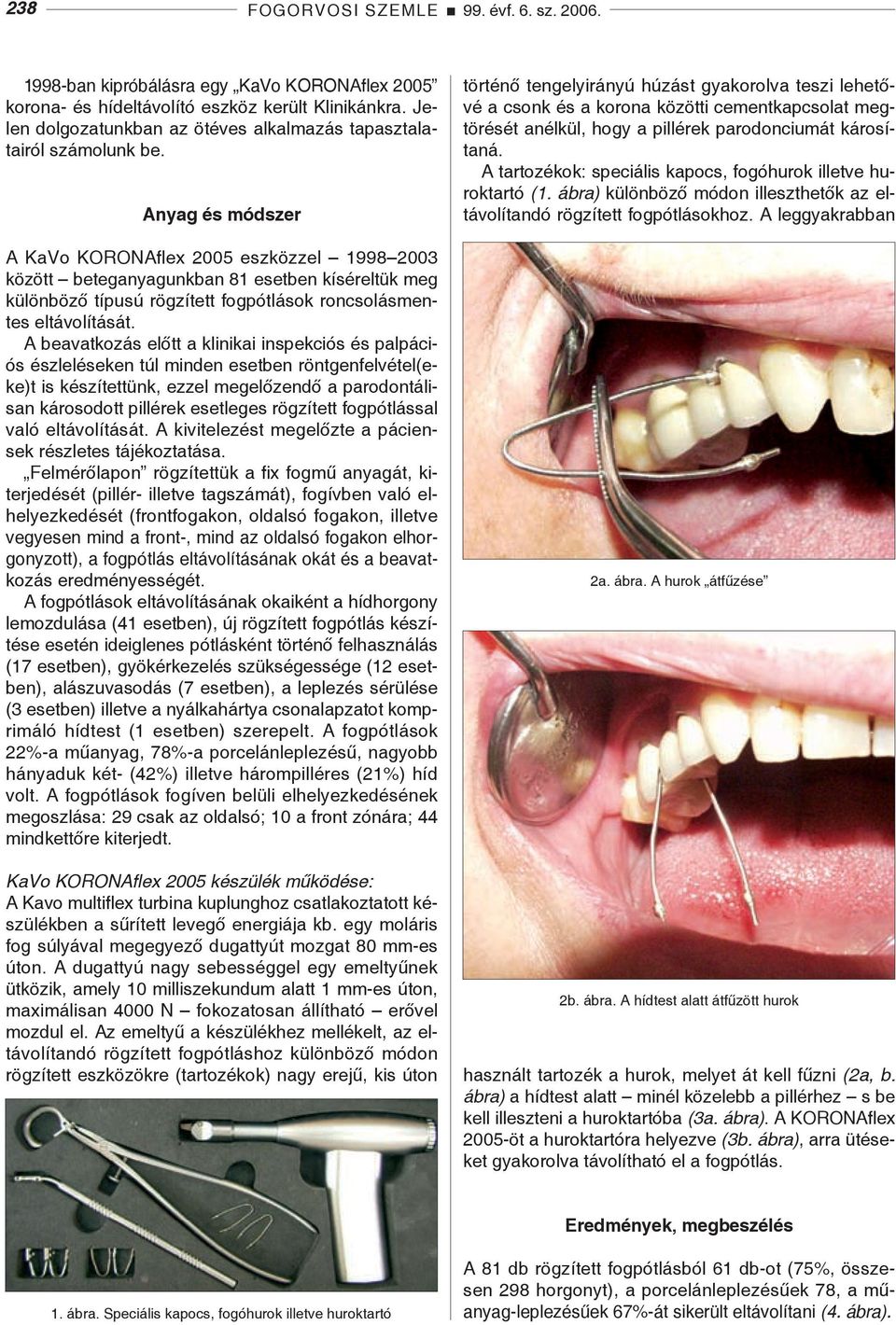 Anyag és módszer A KaVo KORONAflex 2005 eszközzel 1998 2003 között beteganyagunkban 81 esetben kíséreltük meg különböző típusú rögzített fogpótlások roncsolásmentes eltávolítását.