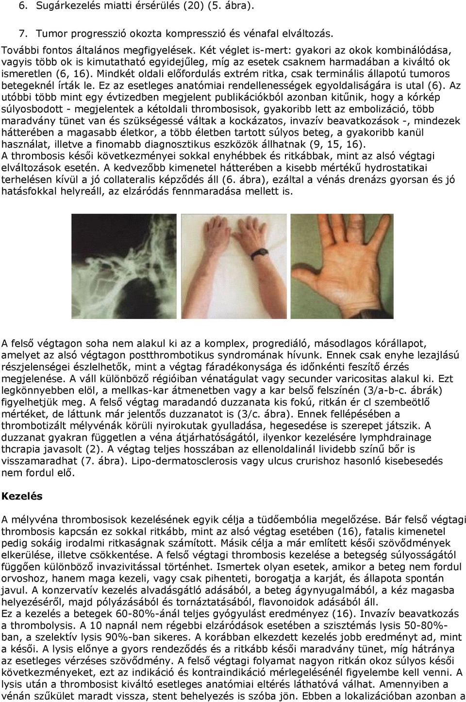 Mindkét oldali előfordulás extrém ritka, csak terminális állapotú tumoros betegeknél írták le. Ez az esetleges anatómiai rendellenességek egyoldaliságára is utal (6).