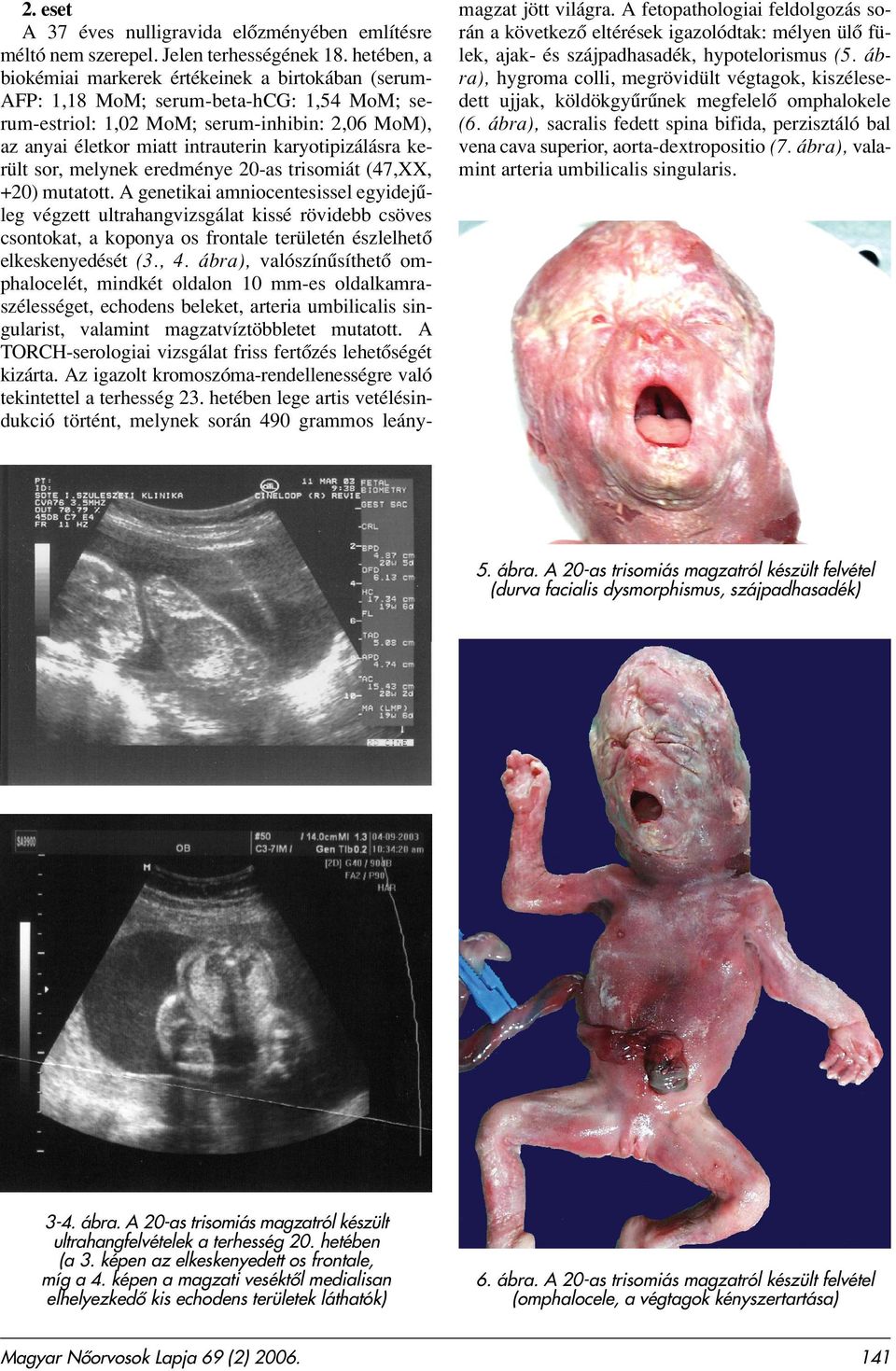 esetet említ, melyben az érintett magzat méhen belüli fejlôdése során túlélte az elsô trimesztert.