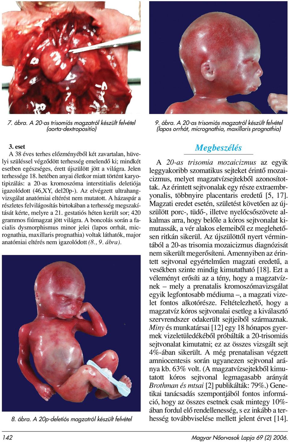 Golden Book Kiadó, 1995. [17] Reish O, Wolach B, Amiel A, Kedar I, Dolfin T, Fejgin M. Dilemma of trisomy 20 mosaicism detected prenatally: is it an innocent finding? Am J Med Genet 1998; 77: 72 75.