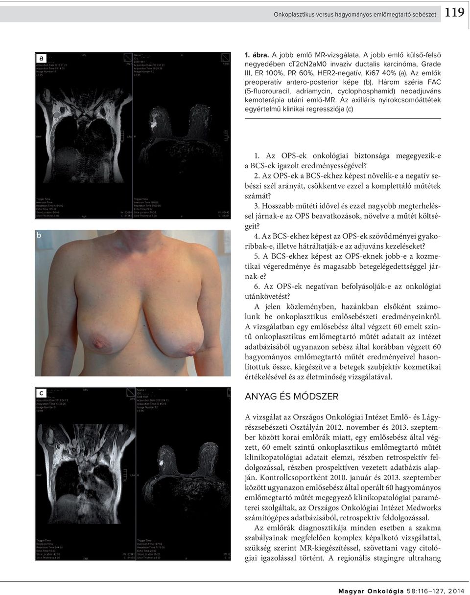 Három széria FAC (5fluorouracil, adriamycin, cyclophosphamid) neoadjuváns kemoterápia utáni emlőmr. Az axilláris nyirokcsomóáttétek egyértelmű klinikai regressziója (c) b c 1.