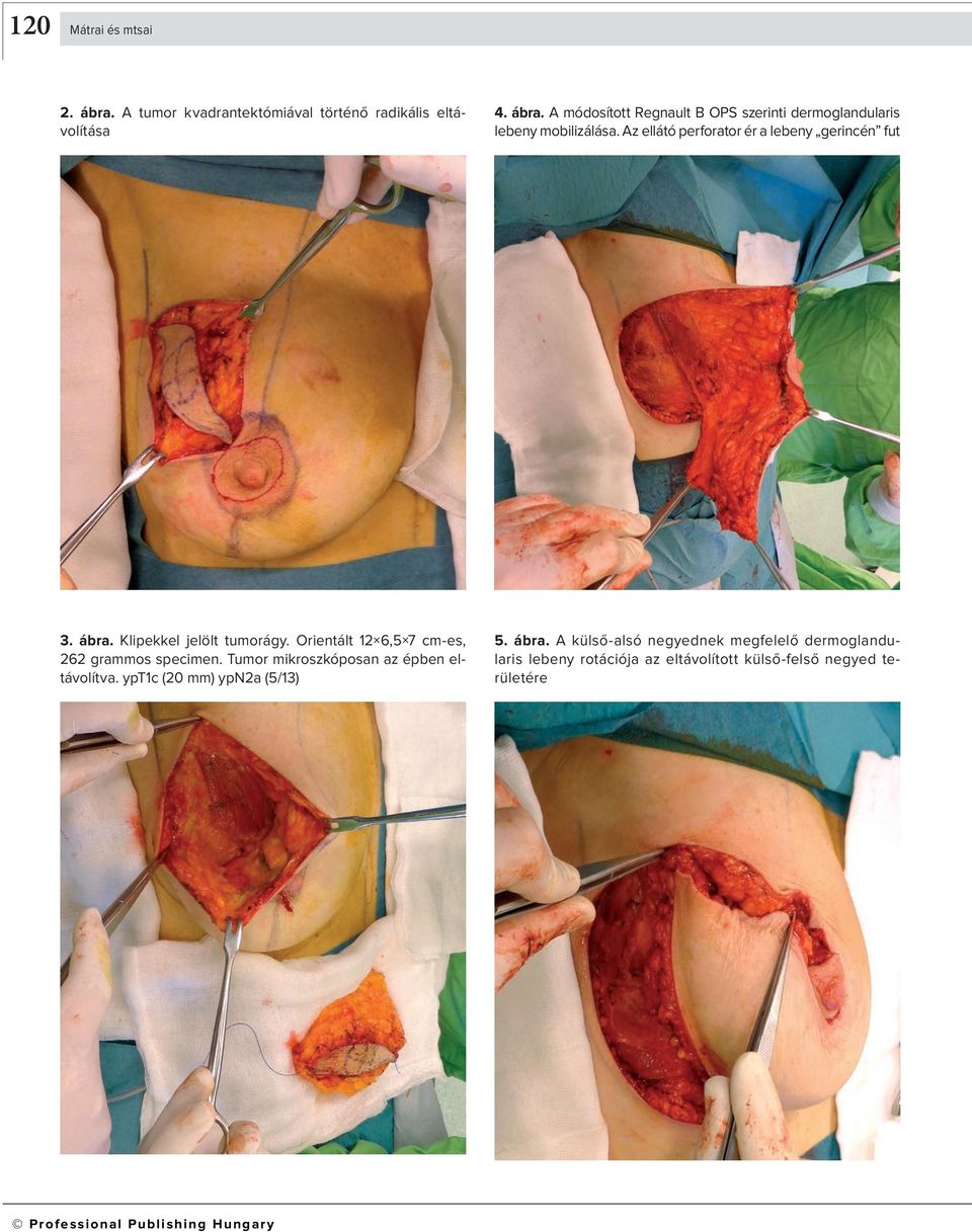 Tumor mikroszkóposan az épben eltávolítva. ypt1c (20 mm) ypn2a (5/13) 5. ábra.