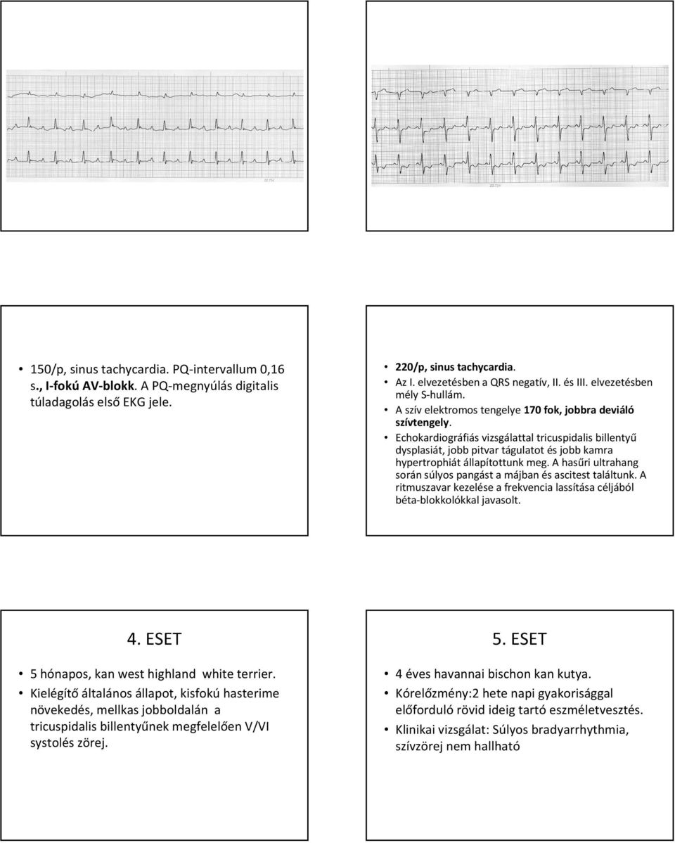 Echokardiográfiás vizsgálattal tricuspidalis billentyű dysplasiát, jobb pitvar tágulatot és jobb kamra hypertrophiátállapítottunk meg.