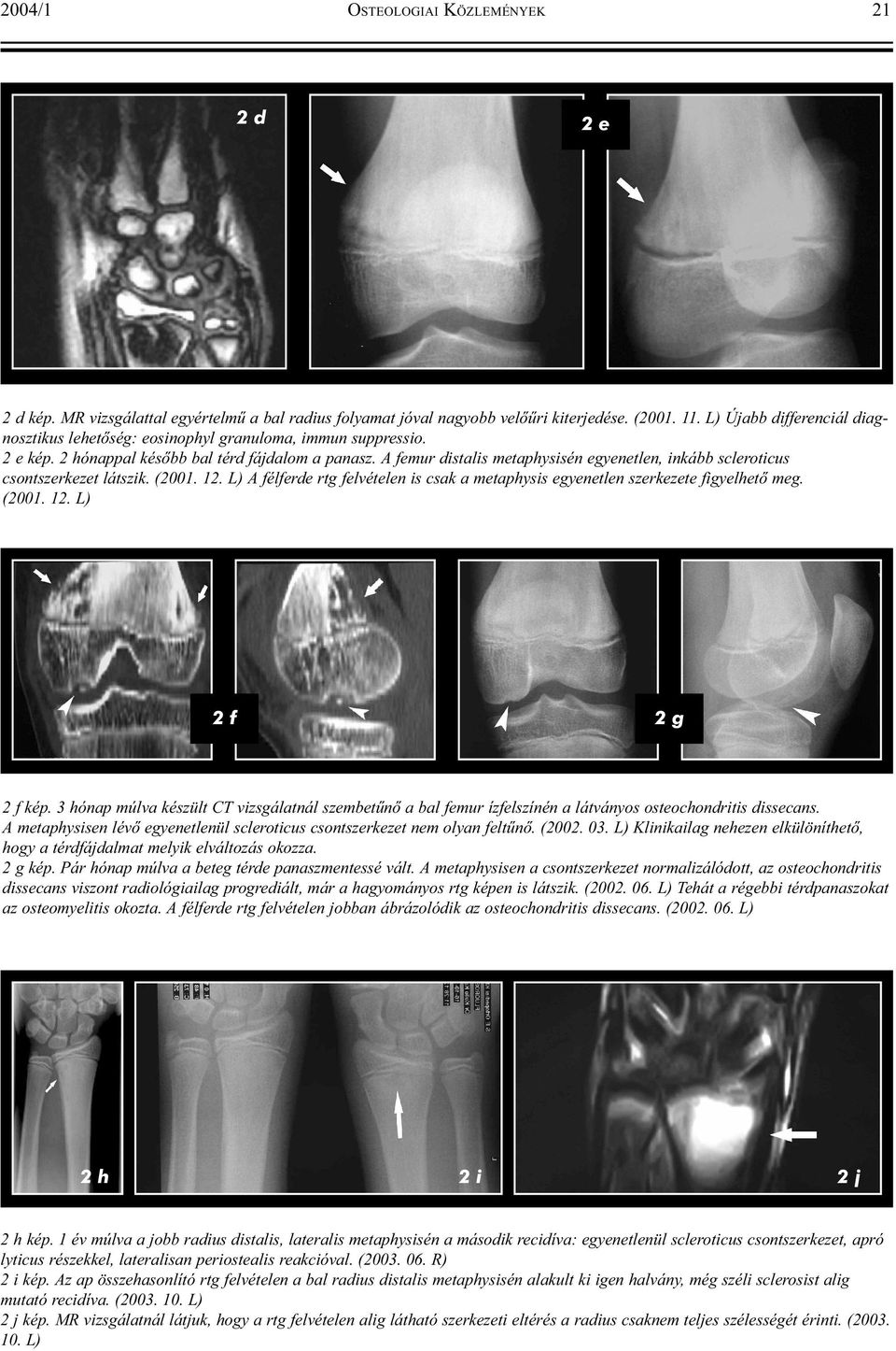 A femur distalis metaphysisén egyenetlen, inkább scleroticus csontszerkezet látszik. (2001. 12. L) A félferde rtg felvételen is csak a metaphysis egyenetlen szerkezete figyelhetõ meg. (2001. 12. L) 2 f 2 g 2 f kép.