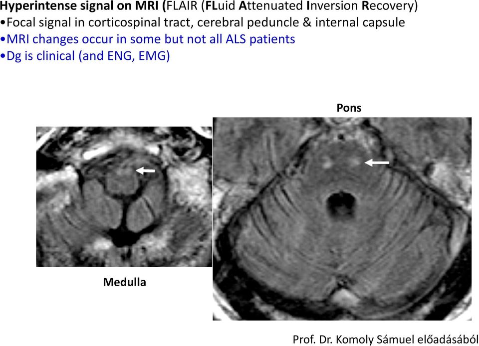 internal capsule MRI changes occur in some but not all ALS patients