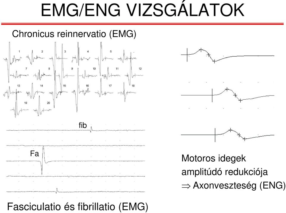 idegek amplitúdó redukciója