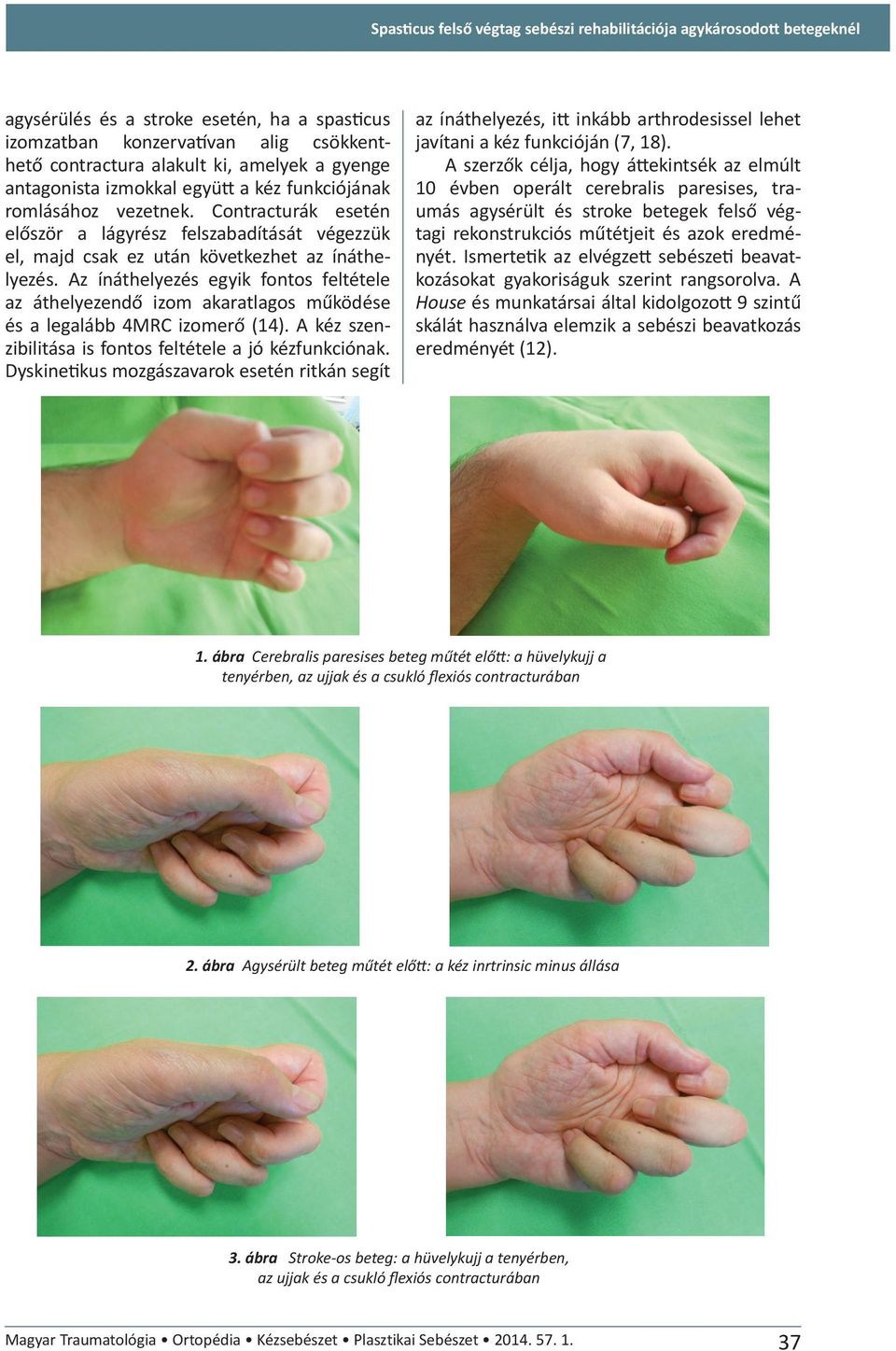 Az ínáthelyezés egyik fontos feltétele az áthelyezendő izom akaratlagos működése és a legalább 4MRC izomerő (14). A kéz szenzibilitása is fontos feltétele a jó kézfunkciónak.