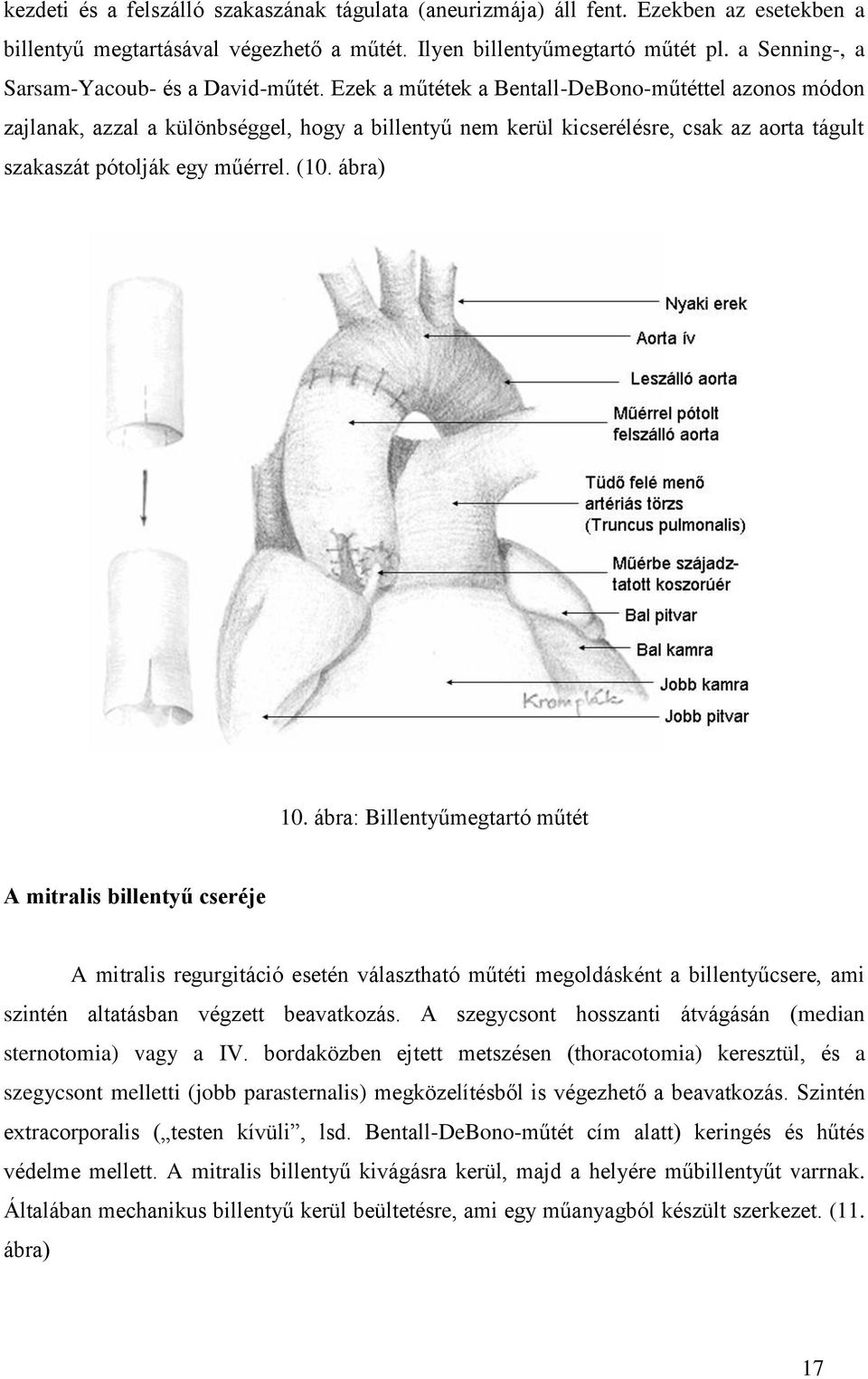 Ezek a műtétek a Bentall-DeBono-műtéttel azonos módon zajlanak, azzal a különbséggel, hogy a billentyű nem kerül kicserélésre, csak az aorta tágult szakaszát pótolják egy műérrel. (10. ábra) 10.