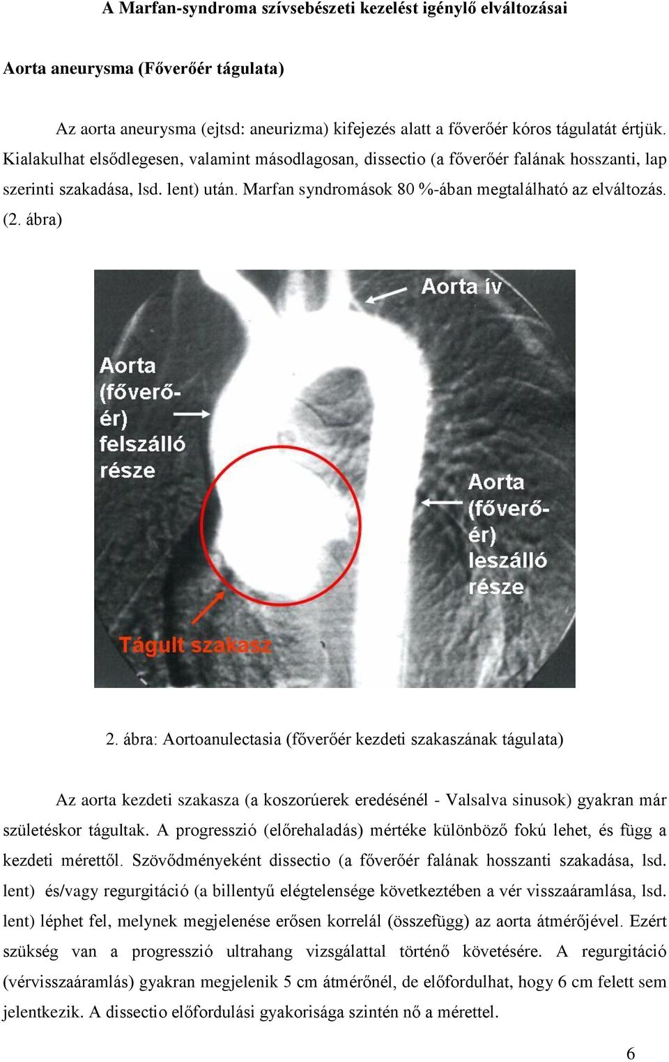 ábra: Aortoanulectasia (főverőér kezdeti szakaszának tágulata) Az aorta kezdeti szakasza (a koszorúerek eredésénél - Valsalva sinusok) gyakran már születéskor tágultak.