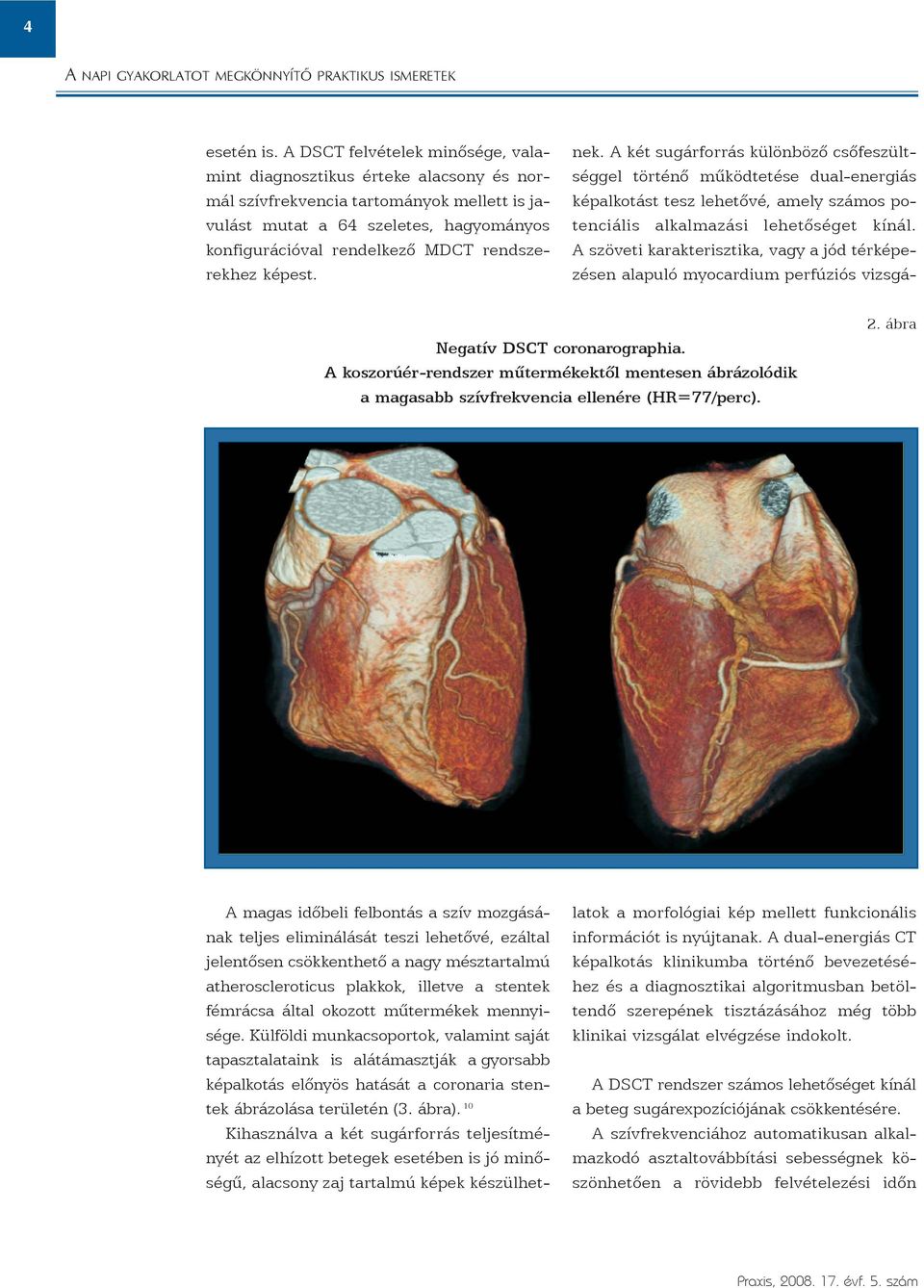 rendszerekhez képest. Negatív DSCT coronarographia. A koszorúér-rendszer mûtermékektõl mentesen ábrázolódik a magasabb szívfrekvencia ellenére (HR=77/perc). 2.