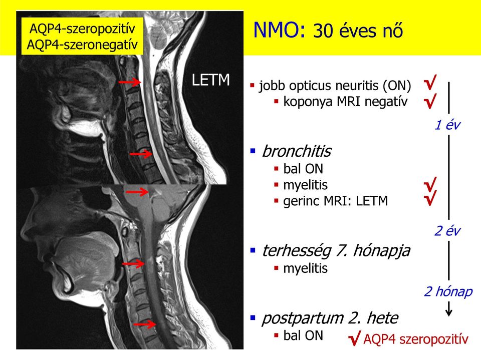 gerinc MRI: LETM 1 év koponya MRI negatív vagy SM-re nem jellemző (vagy NMO-ra jellemző) gerinc MRI 3 csigolyahossz