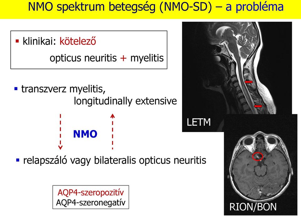 longitudinally extensive NMO LETM relapszáló vagy