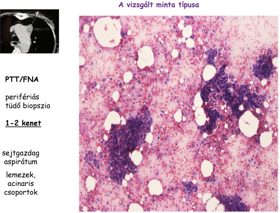 biopszia 1-2 kenet sejtgazdag