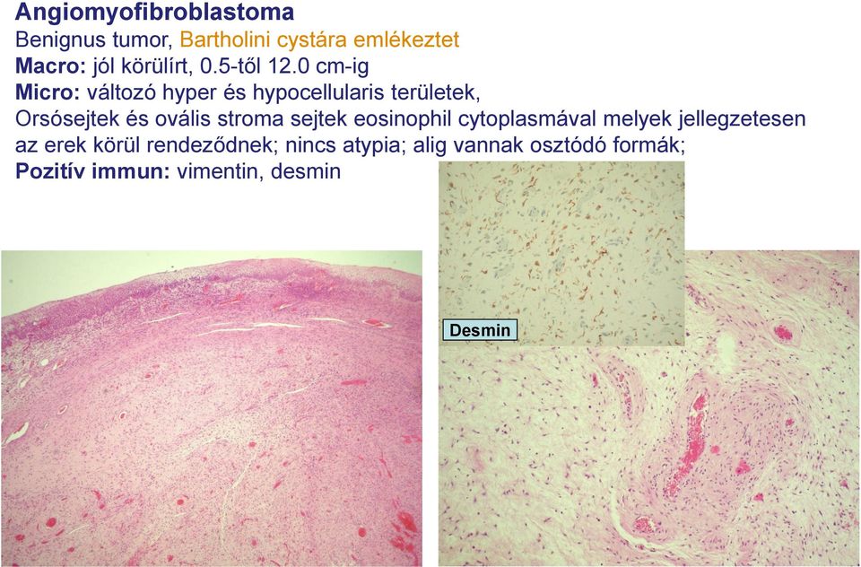 0 cm-ig Micro: változó hyper és hypocellularis területek, Orsósejtek és ovális stroma