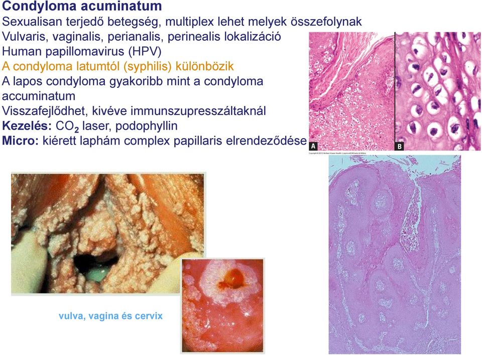 lapos condyloma gyakoribb mint a condyloma accuminatum Visszafejlődhet, kivéve immunszupresszáltaknál