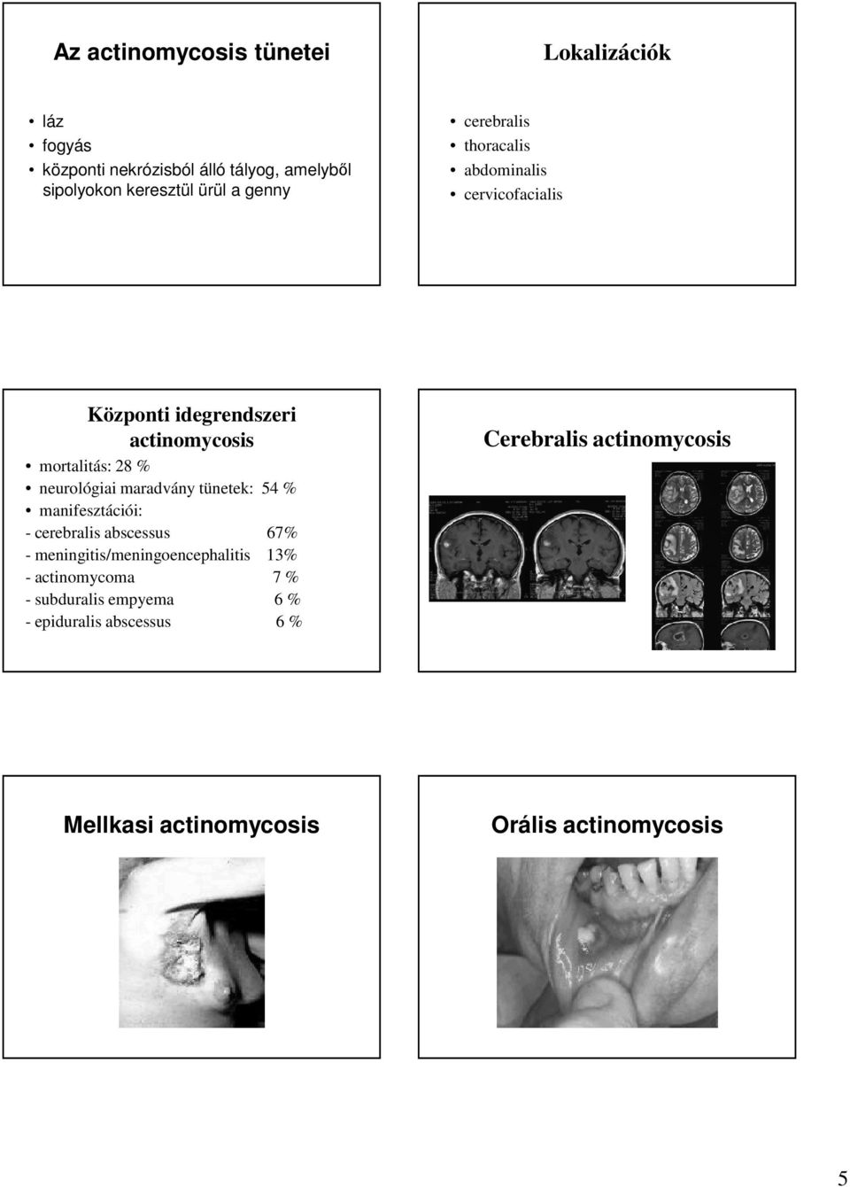 maradvány tünetek: 54 % manifesztációi: - cerebralis abscessus 67% - meningitis/meningoencephalitis 13% - actinomycoma 7