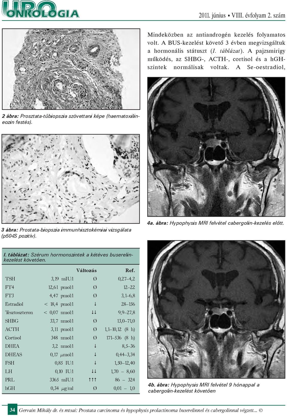 3 ábra: Prostata-biopszia immunhisztokémiai vizsgálata (p504s pozitív). 4a. ábra: Hypophysis MRI felvétel cabergolin-kezelés előtt. I.
