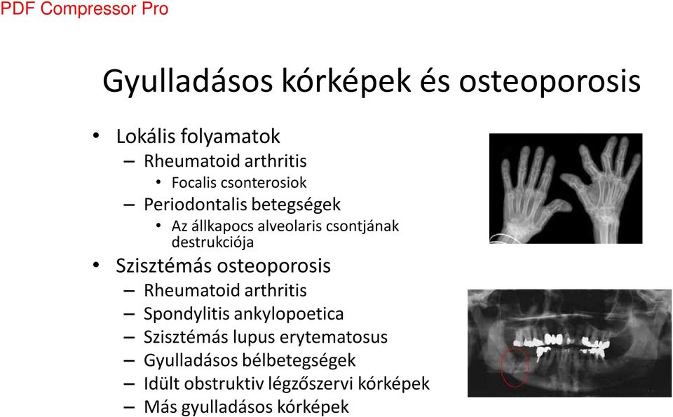 Szisztémás osteoporosis Rheumatoid arthritis Spondylitis ankylopoetica Szisztémás lupus