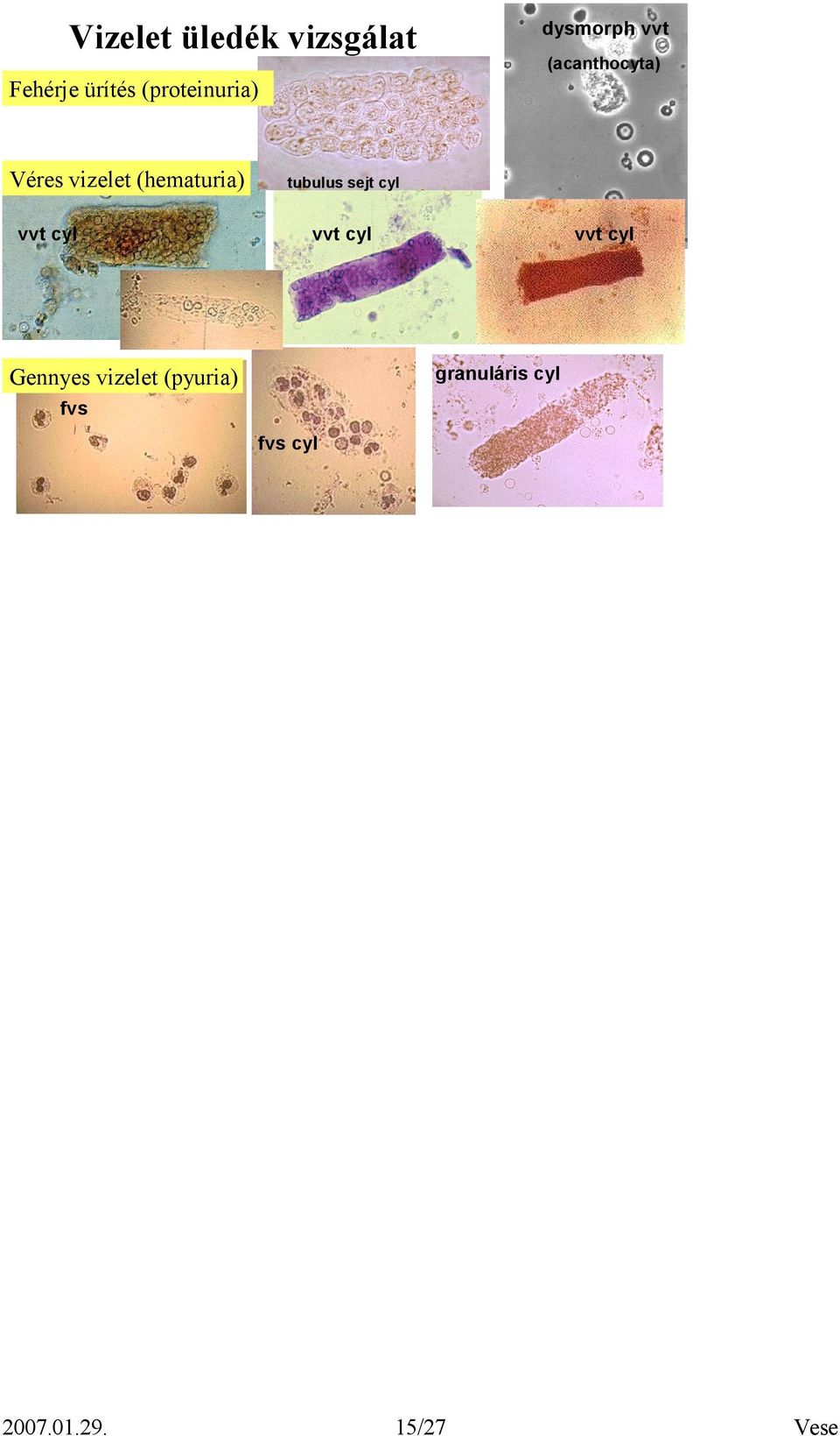 (hematuria) vvt cyl tubulus sejt cyl vvt cyl vvt