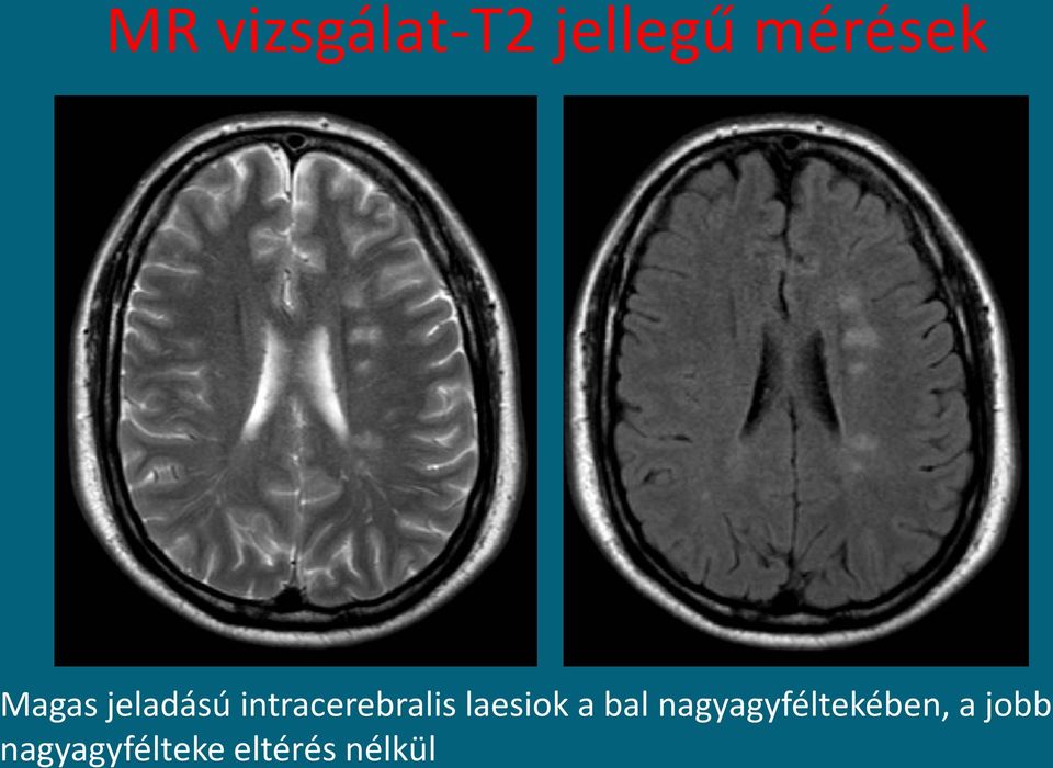 laesiok a bal nagyagyféltekében,