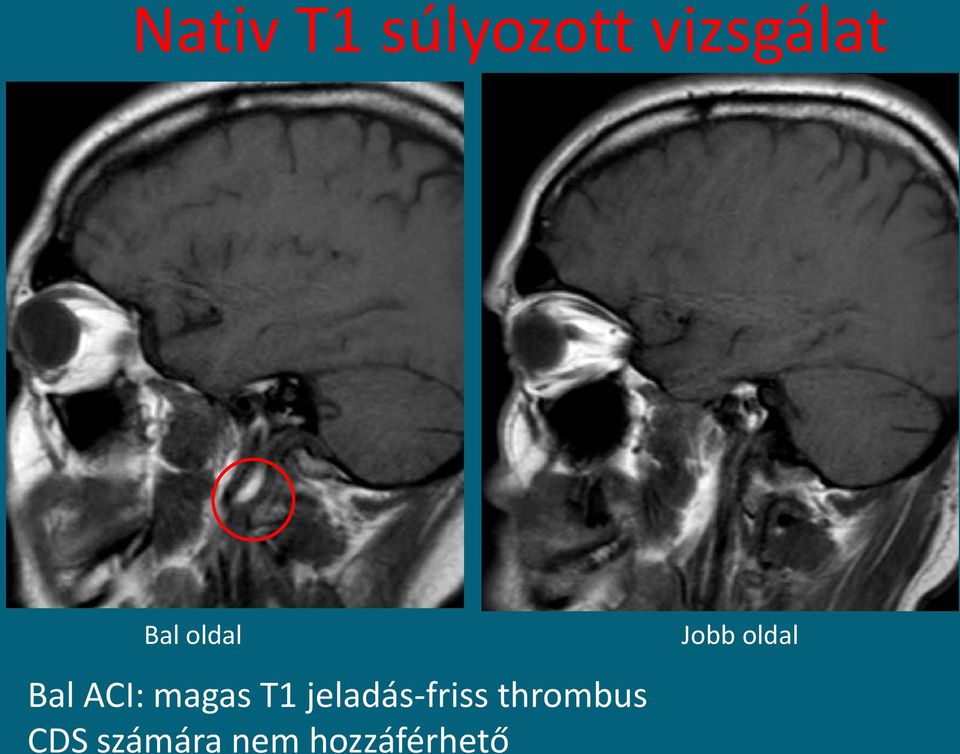 jeladás-friss thrombus CDS