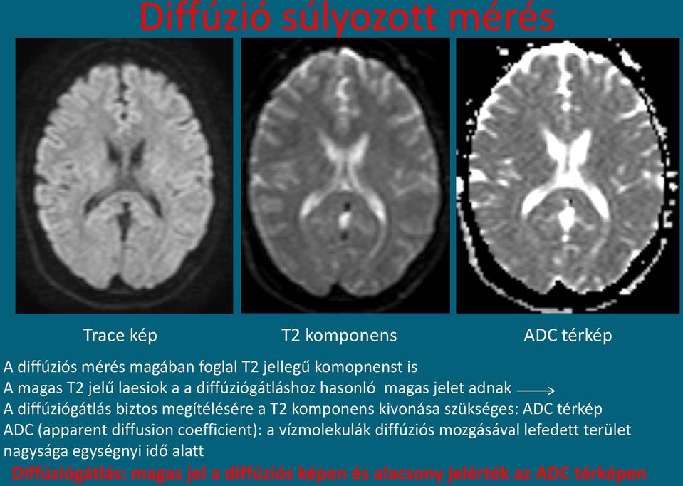 komponens kivonása szükséges: ADC térkép ADC (apparent diffusion coefficient): a vízmolekulák diffúziós mozgásával