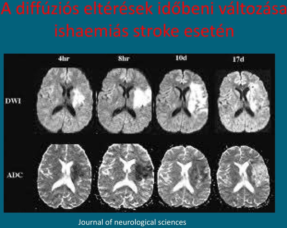 ishaemiás stroke esetén