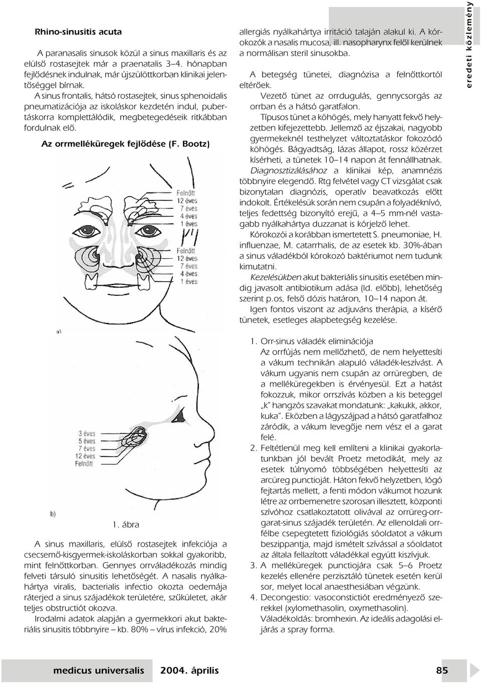 Az orrmelléküregek fejlôdése (F. Bootz) allergiás nyálkahártya irritáció talaján alakul ki. A kórokozók a nasalis mucosa, ill. nasopharynx felôl kerülnek a normálisan steril sinusokba.