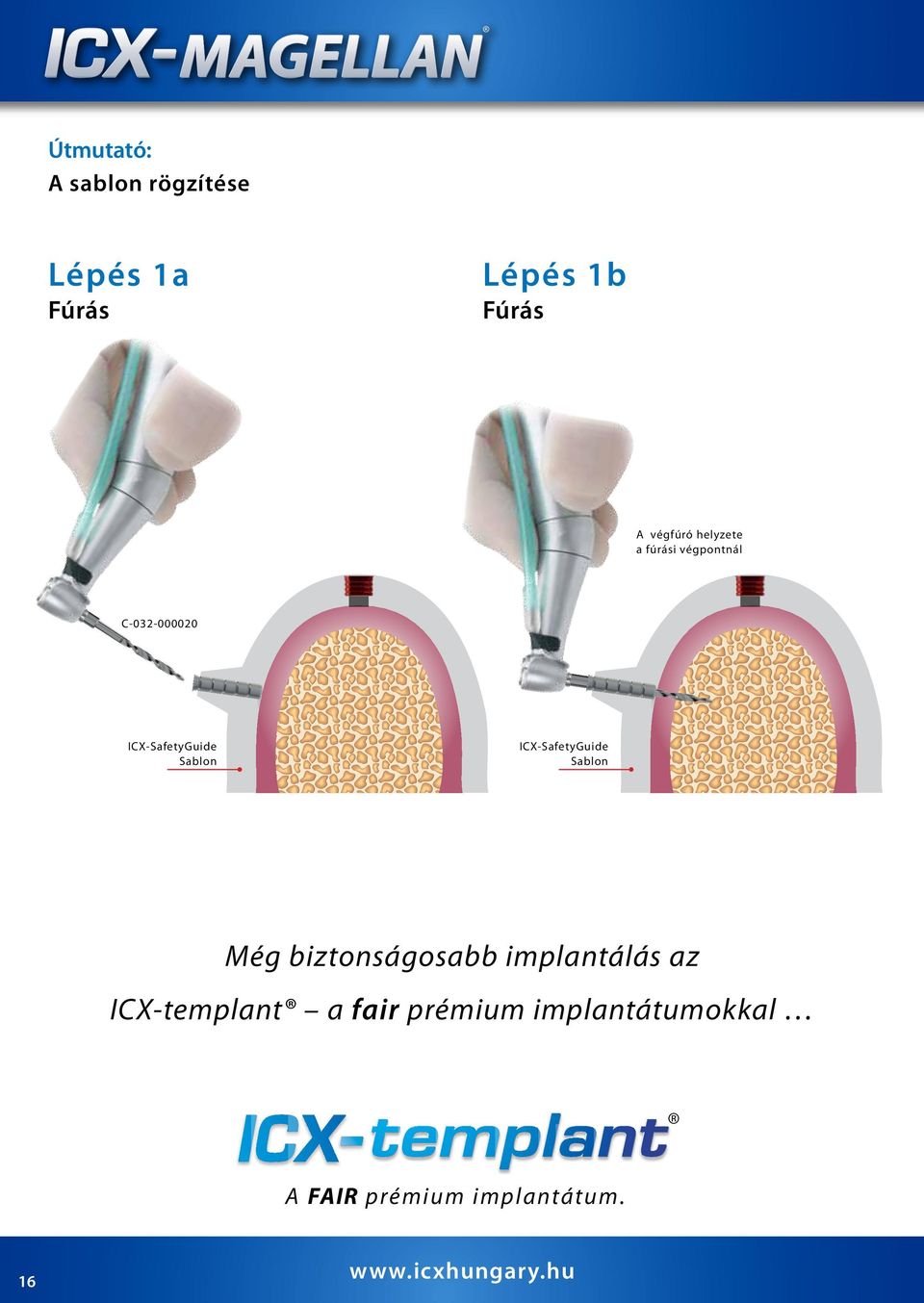 ICX-SafetyGuide Sablon Még biztonságosabb implantálás az ICX-templant a