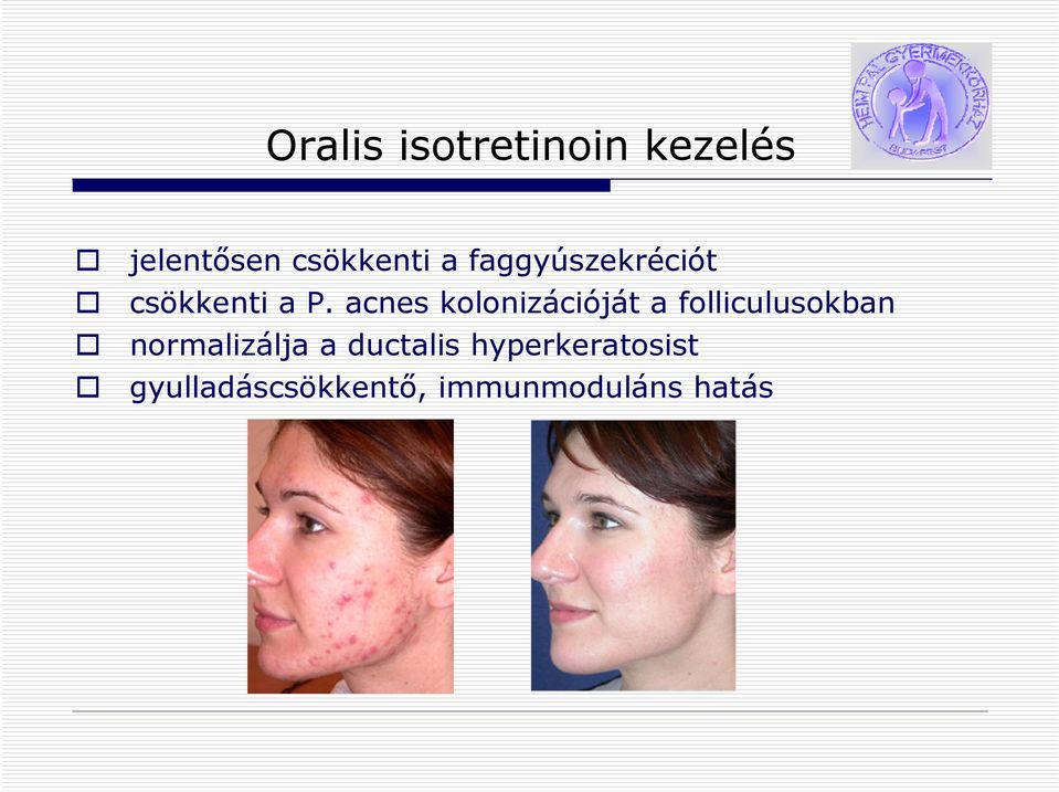 acnes kolonizációját a folliculusokban