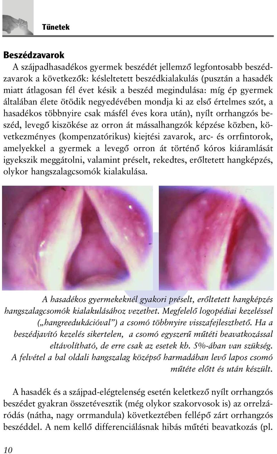 át mássalhangzók képzése közben, következményes (kompenzatórikus) kiejtési zavarok, arc- és orrfintorok, amelyekkel a gyermek a levegõ orron át történõ kóros kiáramlását igyekszik meggátolni,