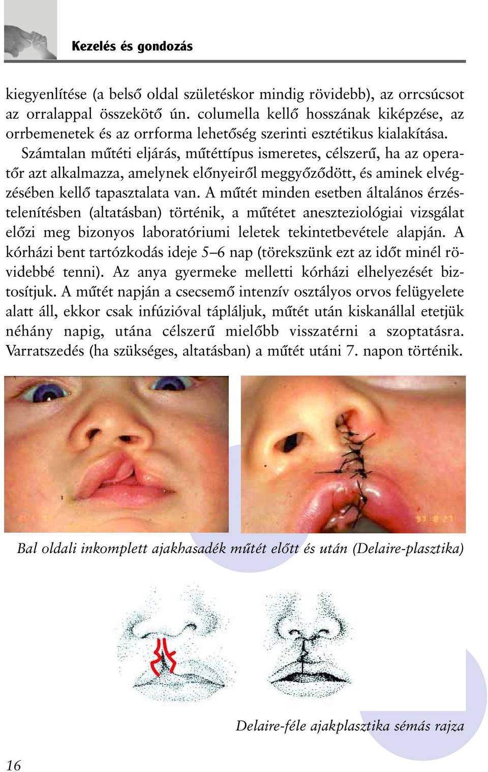 Számtalan mûtéti eljárás, mûtéttípus ismeretes, célszerû, ha az operatõr azt alkalmazza, amelynek elõnyeirõl meggyõzõdött, és aminek elvégzésében kellõ tapasztalata van.