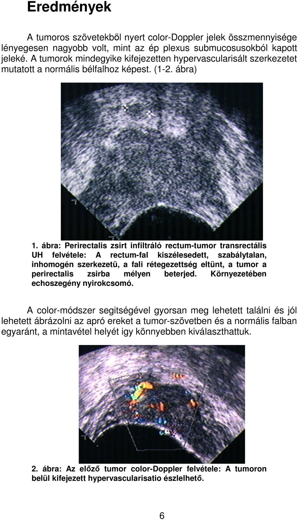 ábra: Perirectalis zsirt infiltráló rectum-tumor transrectális UH felvétele: A rectum-fal kiszélesedett, szabálytalan, inhomogén szerkezetü, a fali rétegezettség eltünt, a tumor a perirectalis zsirba