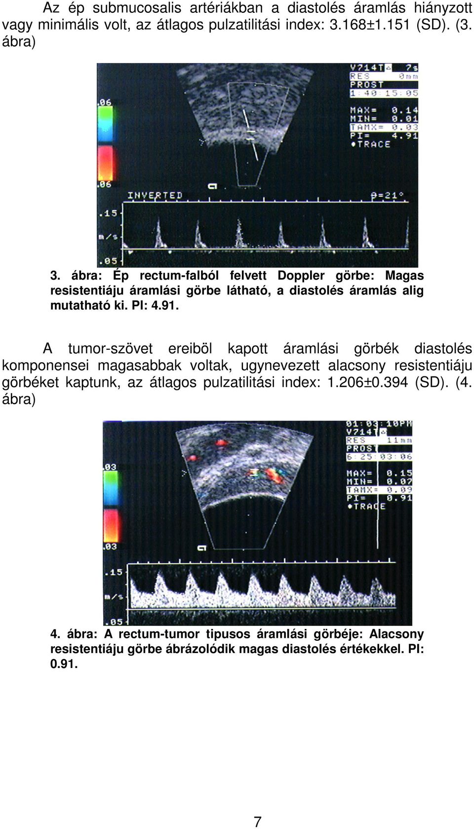 A tumor-szövet ereiböl kapott áramlási görbék diastolés komponensei magasabbak voltak, ugynevezett alacsony resistentiáju görbéket kaptunk, az átlagos