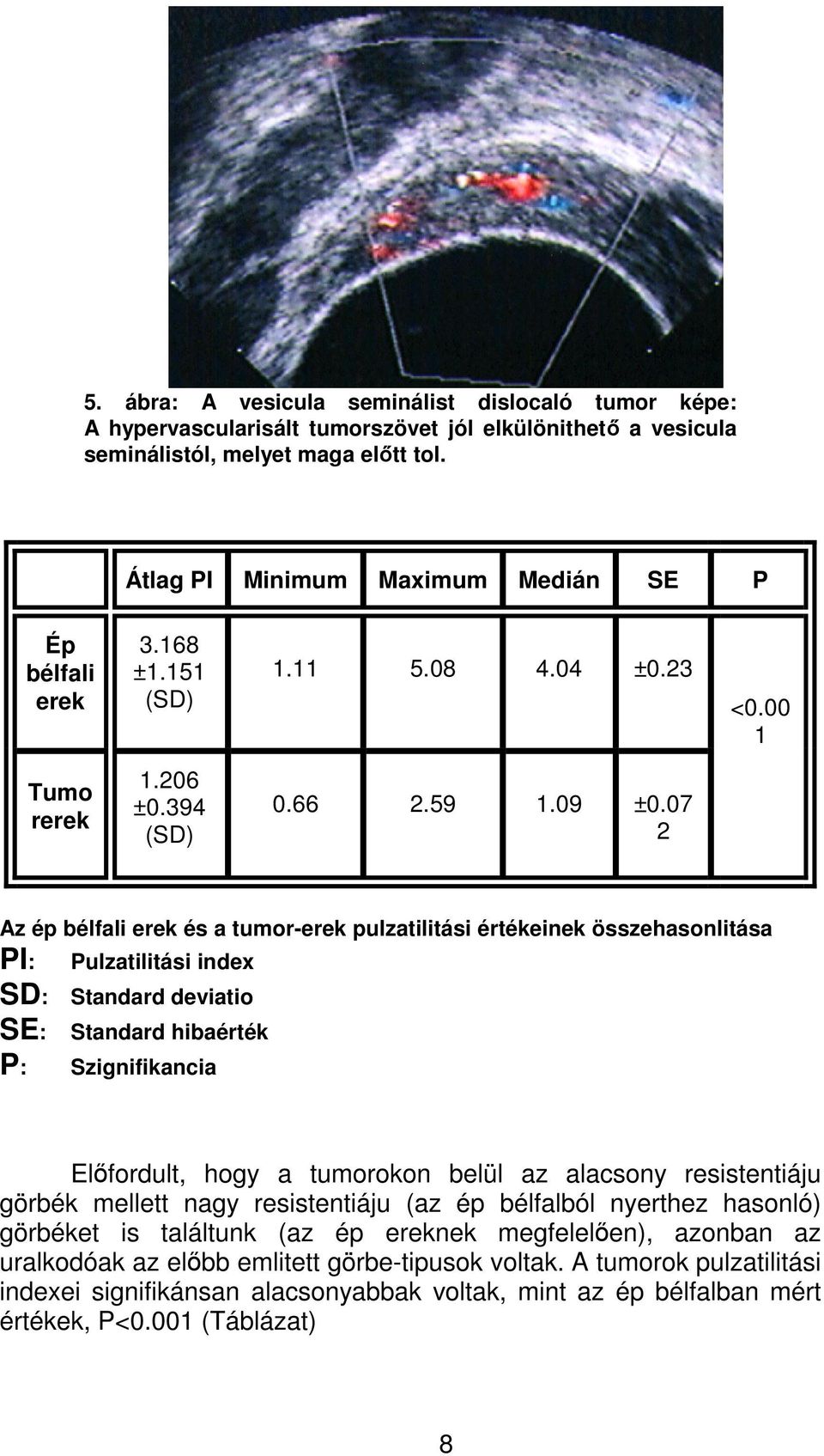 07 2 Az ép bélfali erek és a tumor-erek pulzatilitási értékeinek összehasonlitása PI: SD: SE: Pulzatilitási index Standard deviatio Standard hibaérték P: Szignifikancia Elÿfordult, hogy a tumorokon