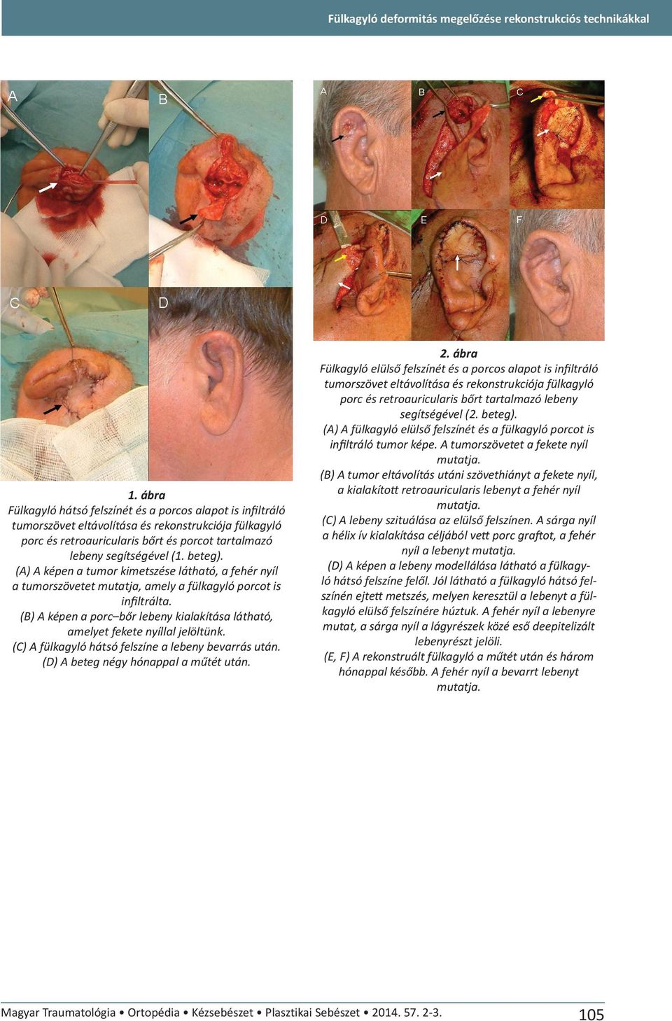 (A) A képen a tumor kimetszése látható, a fehér nyíl a tumorszövetet mutatja, amely a fülkagyló porcot is infiltrálta.