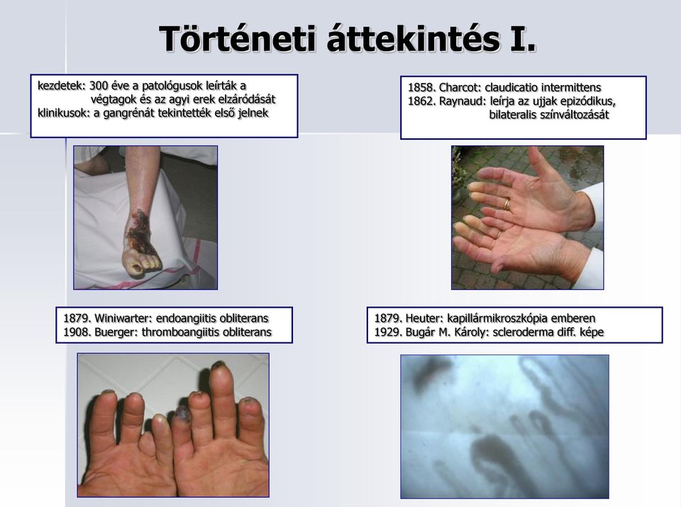 tekintették első jelnek 1858. Charcot: claudicatio intermittens 1862.