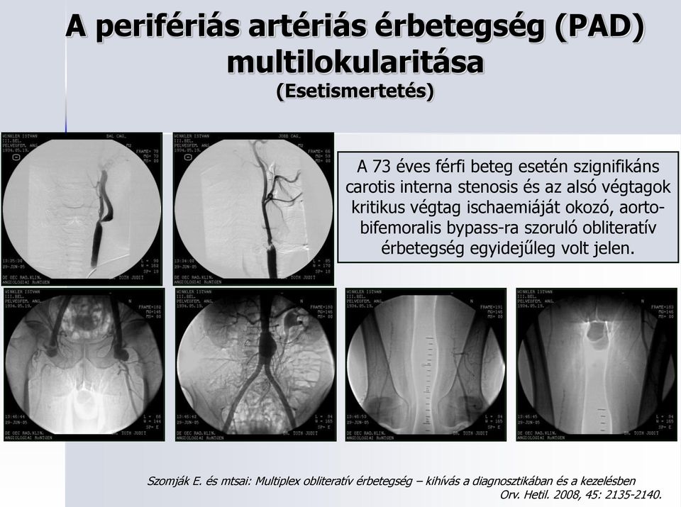 aortobifemoralis bypass-ra szoruló obliteratív érbetegség egyidejűleg volt jelen. Szomják E.