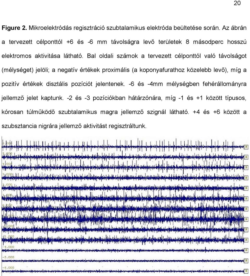 Bal oldali számok a tervezett célponttól való távolságot (mélységet) jelöli; a negatív értékek proximális (a koponyafurathoz közelebb levő), míg a pozitív értékek